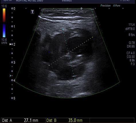 Ultrasound image of the popliteal venous aneurysm (PVA),... | Download Scientific Diagram