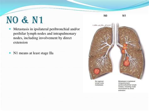 PPT - Lung cancer staging PowerPoint Presentation, free download - ID:4678509