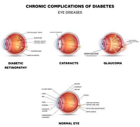 Diabetic Eye Disease | Eye Patient