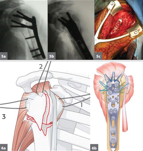 Proximal Humerus Fracture Orthobullets