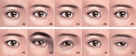 Category of upper eyelid morphology and the preferred double eyelid ...