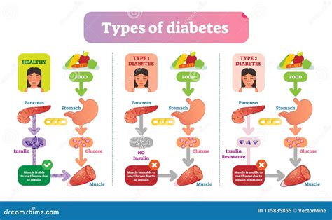 Types of Diabetes Simple Medical Vector Illustration Scheme. Health ...