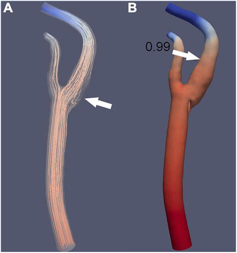 Frontiers | The carotid web: Current research status and imaging features