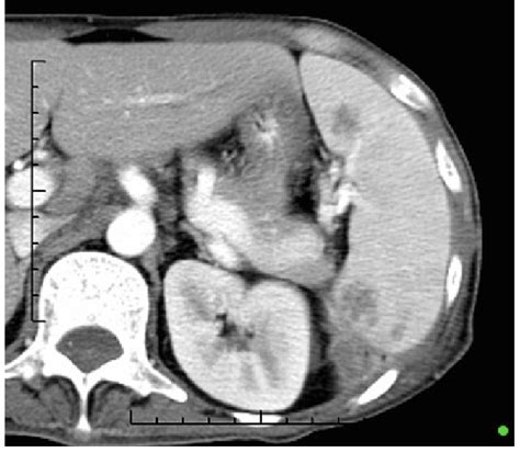 Splenic abscess in a 40-year-old male with multifocal abscesses as seen... | Download Scientific ...