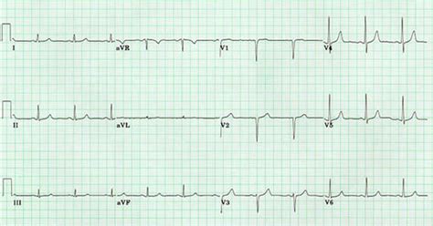 Infarction: Anteroseptal Infarct Ecg