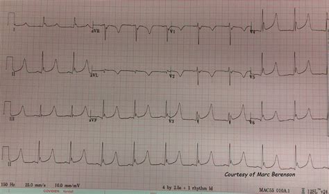 Osborn Waves | ECG Guru - Instructor Resources