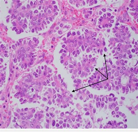 Specimen histology showing papillary structures (black arrows)... | Download Scientific Diagram