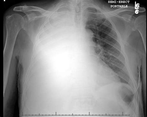 Lung Consolidation Vs Pleural Effusion