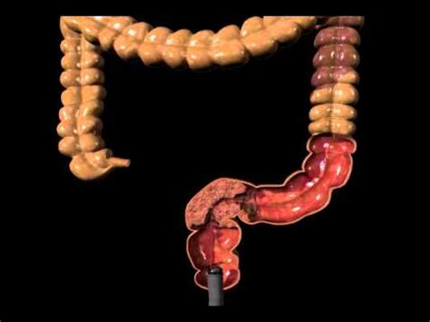 Cook Evolution duodenal & Colonic Animation stent placement - YouTube