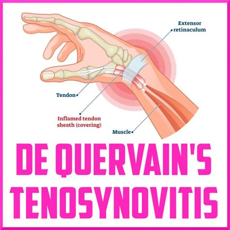 De Quervain Syndrome Treatment