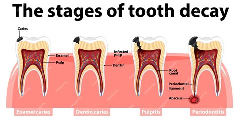 Free Vector | Infographic of human in the stages of tooth decay