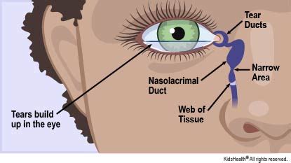 Tear-Duct Blockage