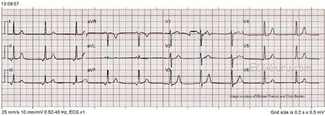 Junctional or Low Atrial Rhythm | ECG Guru - Instructor Resources