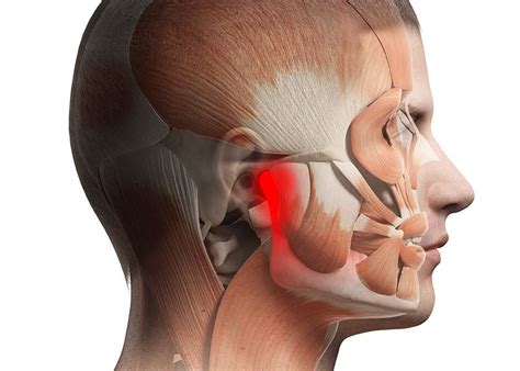 TMJ Treatment – Columbus, GA - Auburn, AL - Macon, GA - Splint Therapy