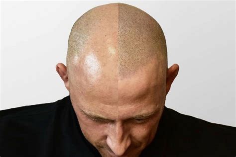 Scalp Micropigmentation Aftercare Tips