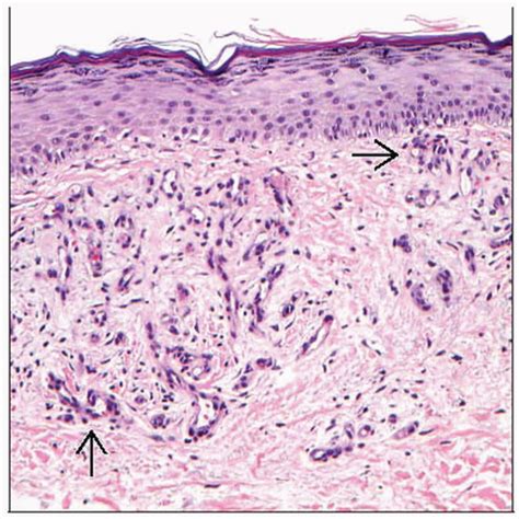 Stasis Dermatitis | Basicmedical Key