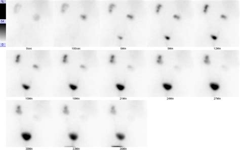 -Nuclear medicine renal scan demonstrates early uptake of radiotracer ...