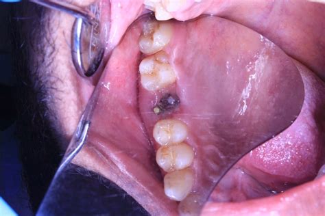 Upper decayed molar extraction and implant placement