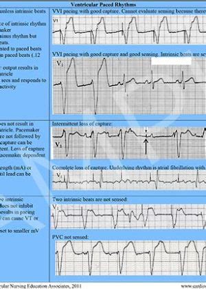 Cardiac Arrhythmia Reference Chart (PDF) – Cardiovascular Nursing Education Associates