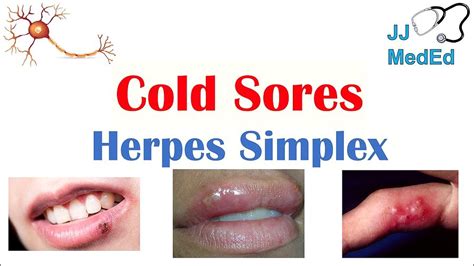 ORAL HERPES. Causes, Signs & Symptoms, Treatment - OdontoFarma