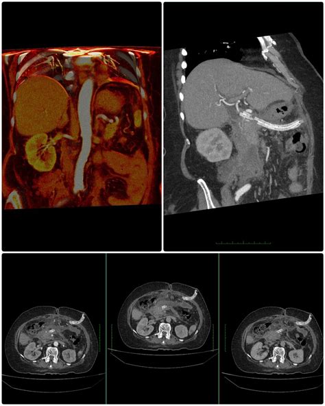 (PDF) Necrotizing pancreatitis Treatment