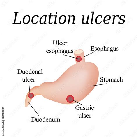 Esophagus ulcer affected. Ulcer of esophagus. Stomach ulcer Stock ...