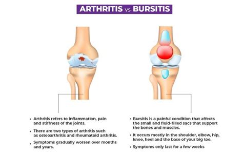 Difference Between Arthritis And Bursitis?