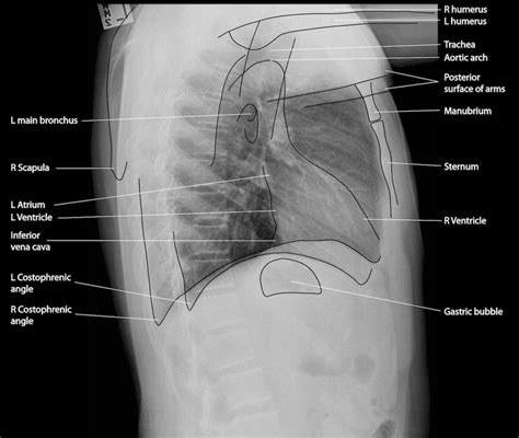 Normal Chest X-Ray • LITFL Medical Blog • Labelled Radiology