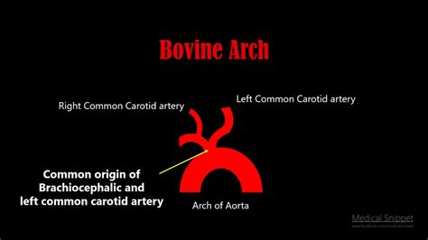 Bovine arch | Misnomer | Anatomy - YouTube