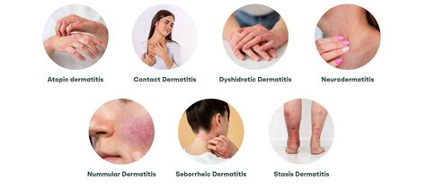 Dermatitis Decoded: Types, Triggers, and Tips for Relief - Revitalis