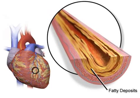 How to Remove Plaque from Arteries