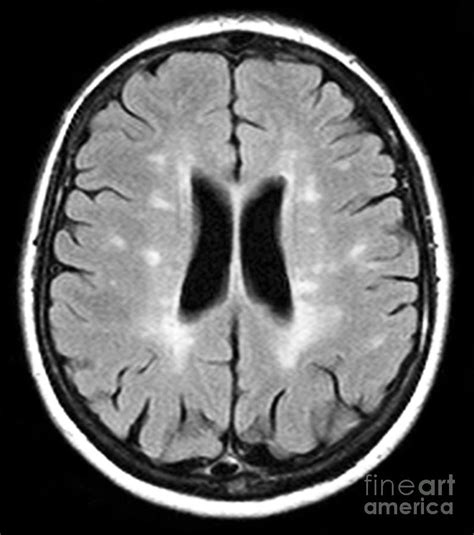 Multiple Sclerosis, Mri Scan Photograph by Du Cane Medical Imaging Ltd.