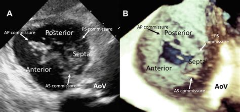 Visualization of the tricuspid valve with 2- and 3-dimensional... | Download Scientific Diagram