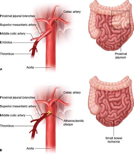 SMA Embolectomy | Thoracic Key