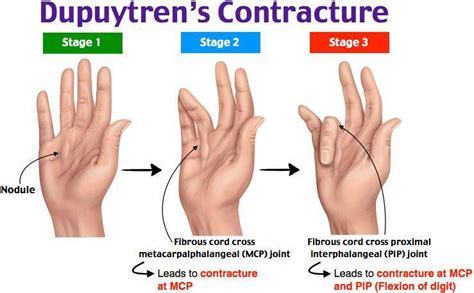 3D Printing Videos Projects Posts #3DPrinterKidsDesign Info: 1843630286 | Medical mnemonics ...