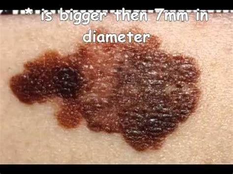 Itchy Mole ?How To Remove Itchy Moles - YouTube