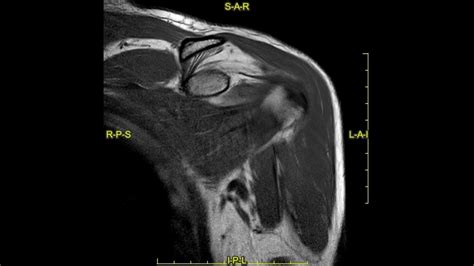 Bankart lesion of the shoulder - complete MRI examination - YouTube