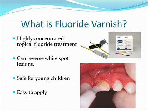 Fluoride Varnish For Kids