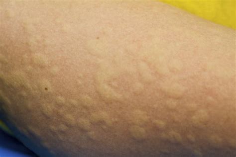 Rash That Looks Like Mosquito Bites | LoveToKnow