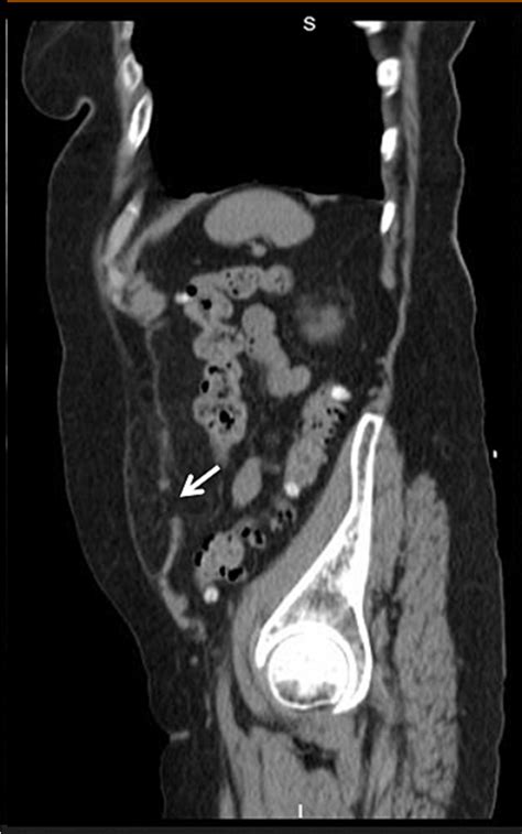 CT scan of a 69-year-old female with Spigelian hernia. Adipose tissue ...