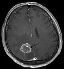 Concussion Brain MRI's, CT scans, and EEG - Concussion Clinic