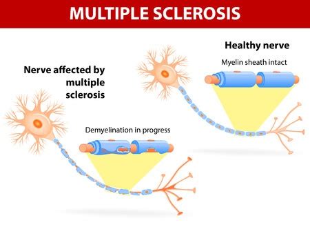 Multiple sclerosis: causes, symptoms, treatment and complications