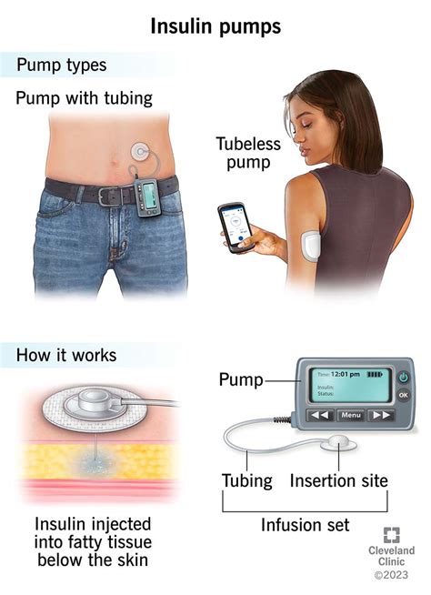 Insulin Pump: What It Is, How It Works & Types