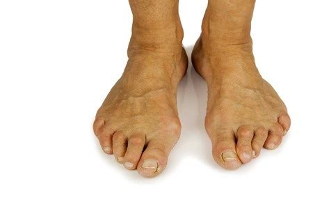 Bad Bunions May Need Surgery | Your Next Step Podiatry