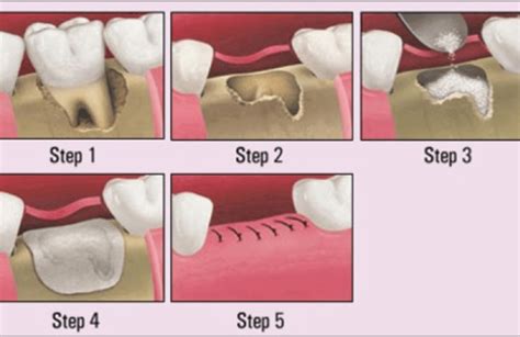 Bone Graft | Oaks Dental Korea