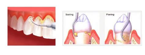 Scaling and Root Planing (SRP) = A Deep Cleaning – Wrigleyville Dental