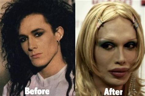 Pete Burns before and after plastic surgery 44 | Celebrity plastic ...