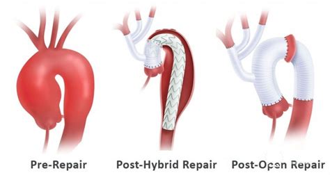 Aortic arch repair surgery