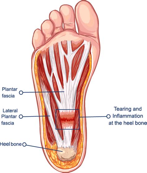 Foot Pain and Heel Pain | Body Active Physio