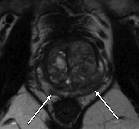 Radiologist, Be Aware: Ten Pitfalls That Confound the Interpretation of Multiparametric Prostate ...